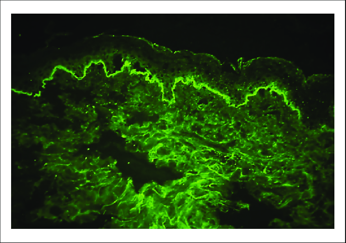 Direct immunofluorescence IgG microscopy image