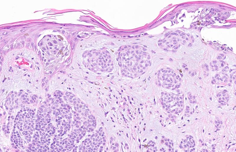 Melanoma and skin cancers