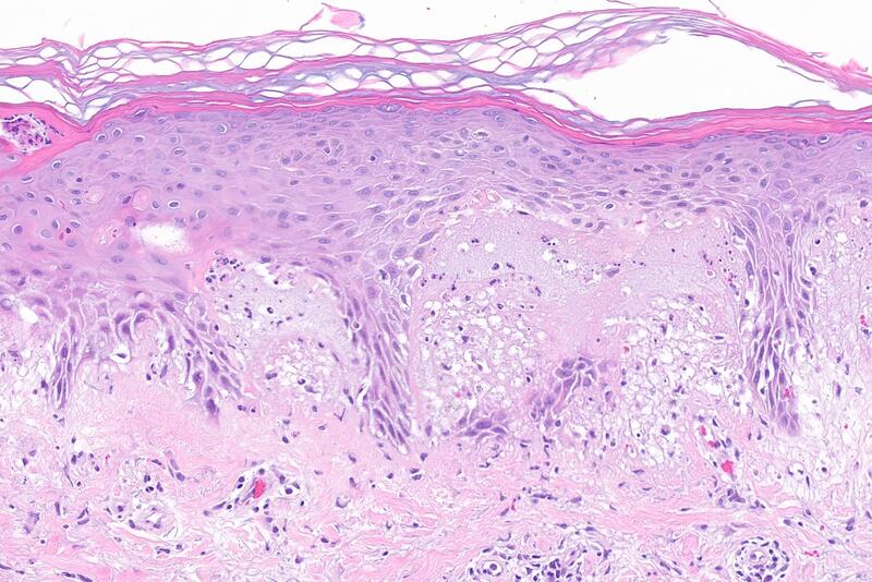 Autoimmune skin disorders