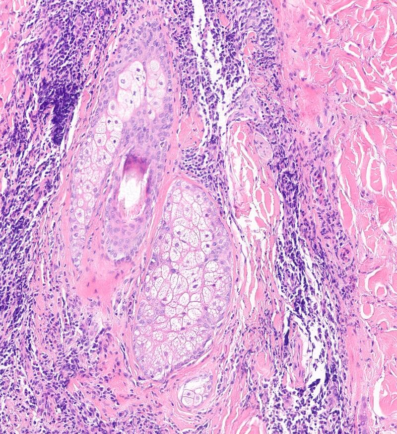 Nail and hair pathology