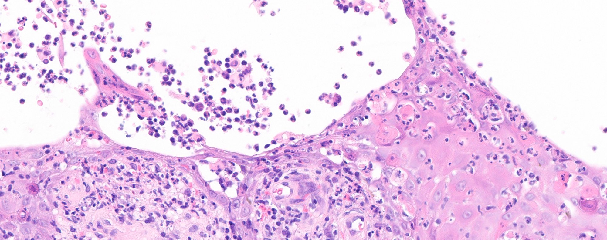 Inflammatory skin diseases